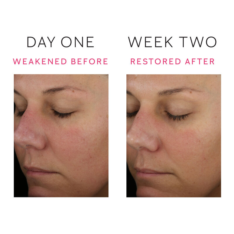 A set of before and after images showing a reduction in the appearance of skin redness from day one to week two&nbsp;