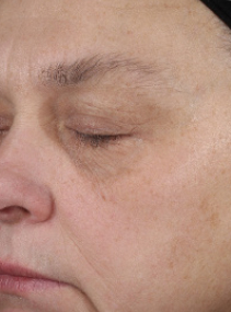 Sujeto A despu&eacute;s de usar Mary Kay Clinical Solutions Retinol 0.3 cada noche durante 12 semanas
