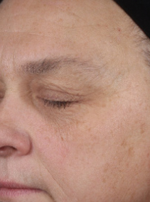 Sujeto A antes de usar Mary Kay Clinical Solutions Retinol 0.3